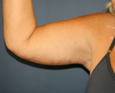 Feel Beautiful - Arm Lift San Diego 29 - After Photo